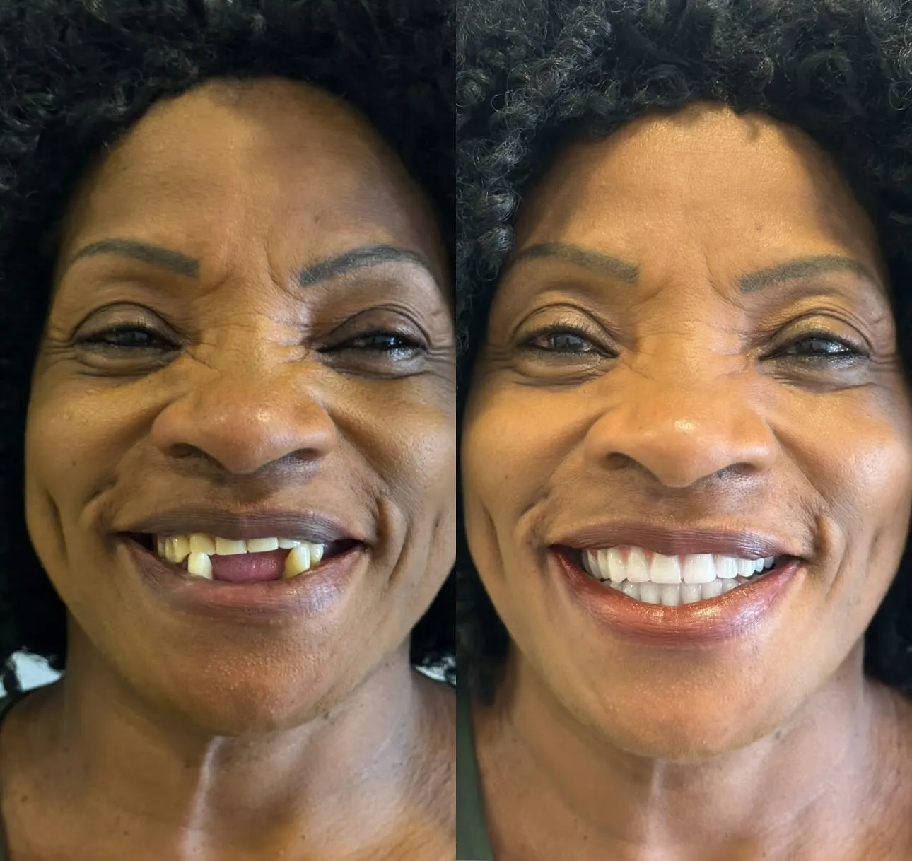 Caso de antes e depois de paciente da Lottus Clinic