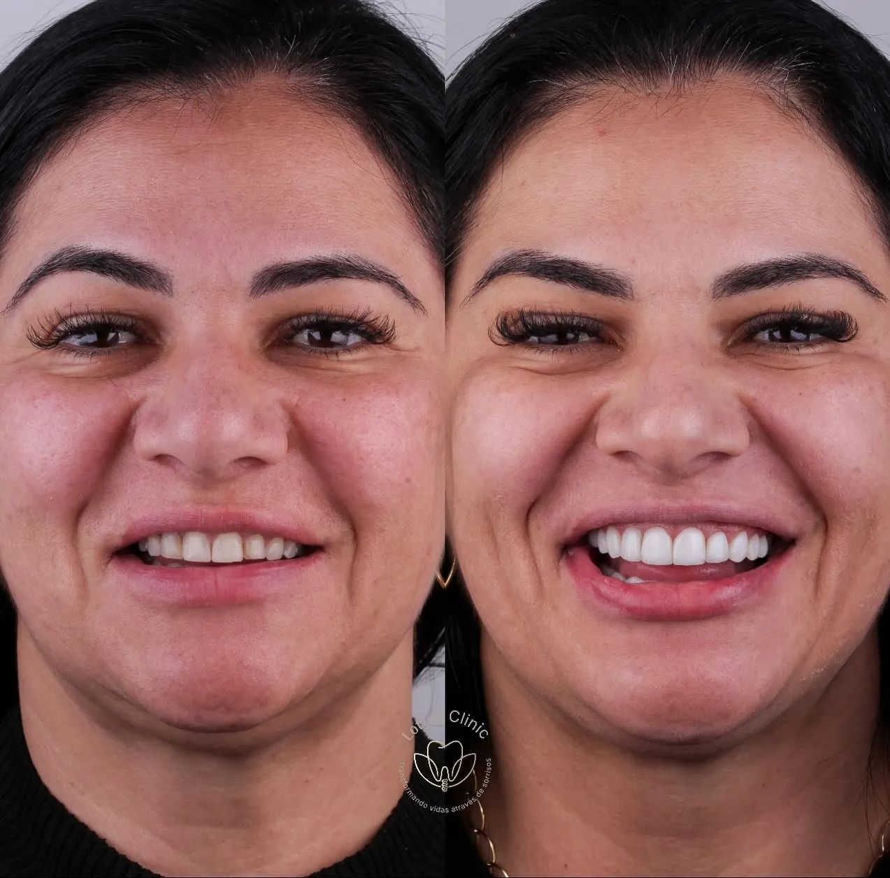 Antes e depois de facetas na Lottus Clinic