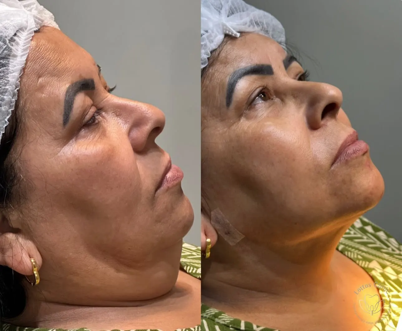 Antes e depois de lipo de papada com platismoplastia na Lottus Clinic